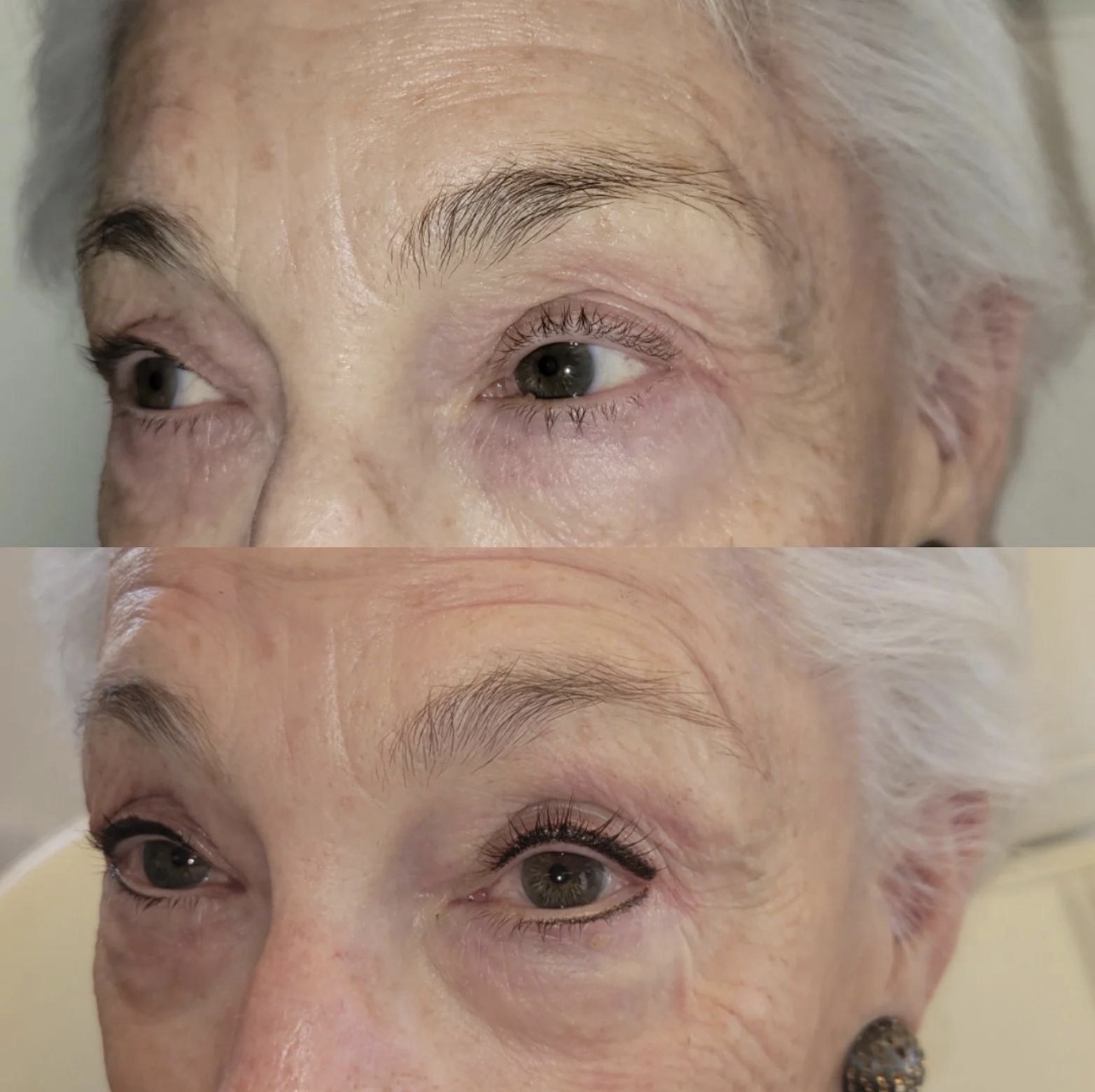Classic Eye Definition Before and After