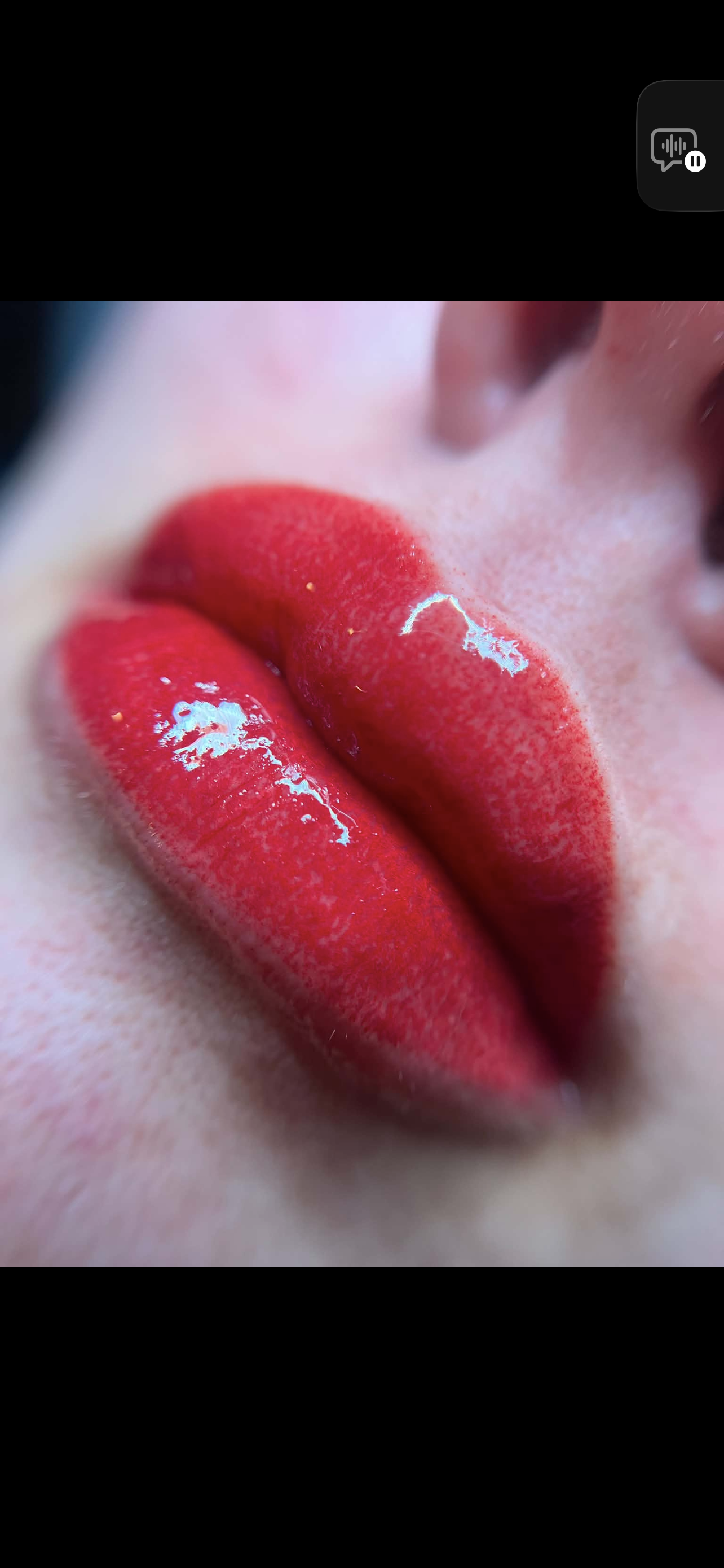 Velvet Lip Enhancement Before and After
