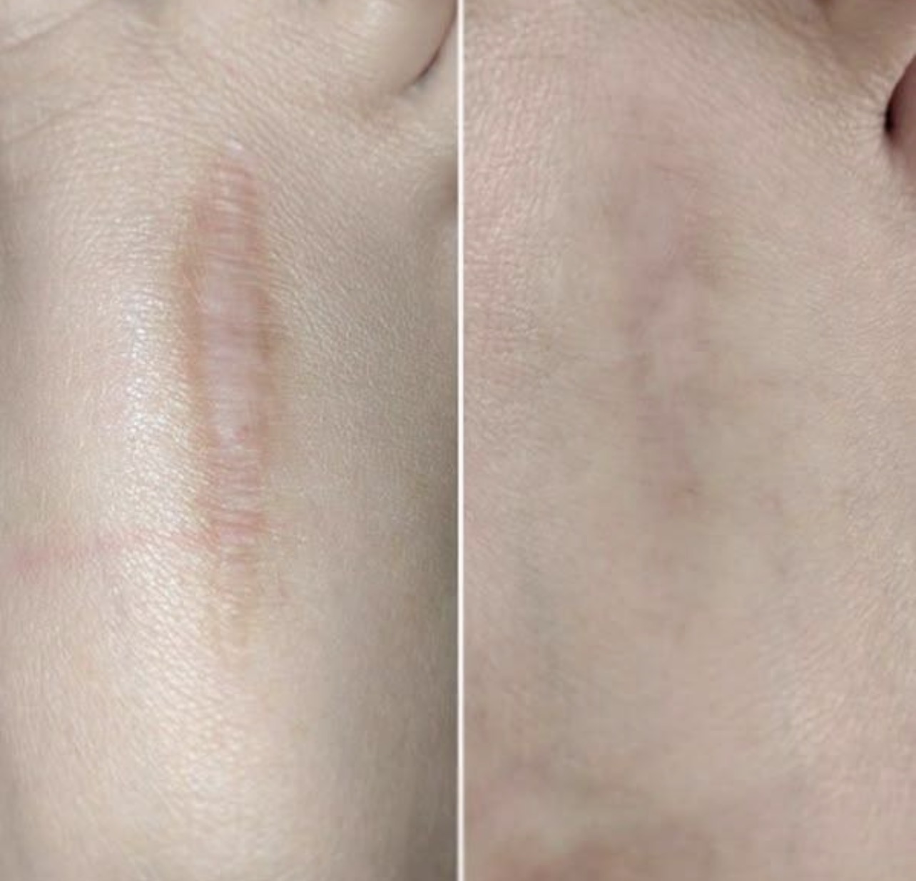 Surgical Scar Camouflage showing healed breast surgery scar with improved color blending