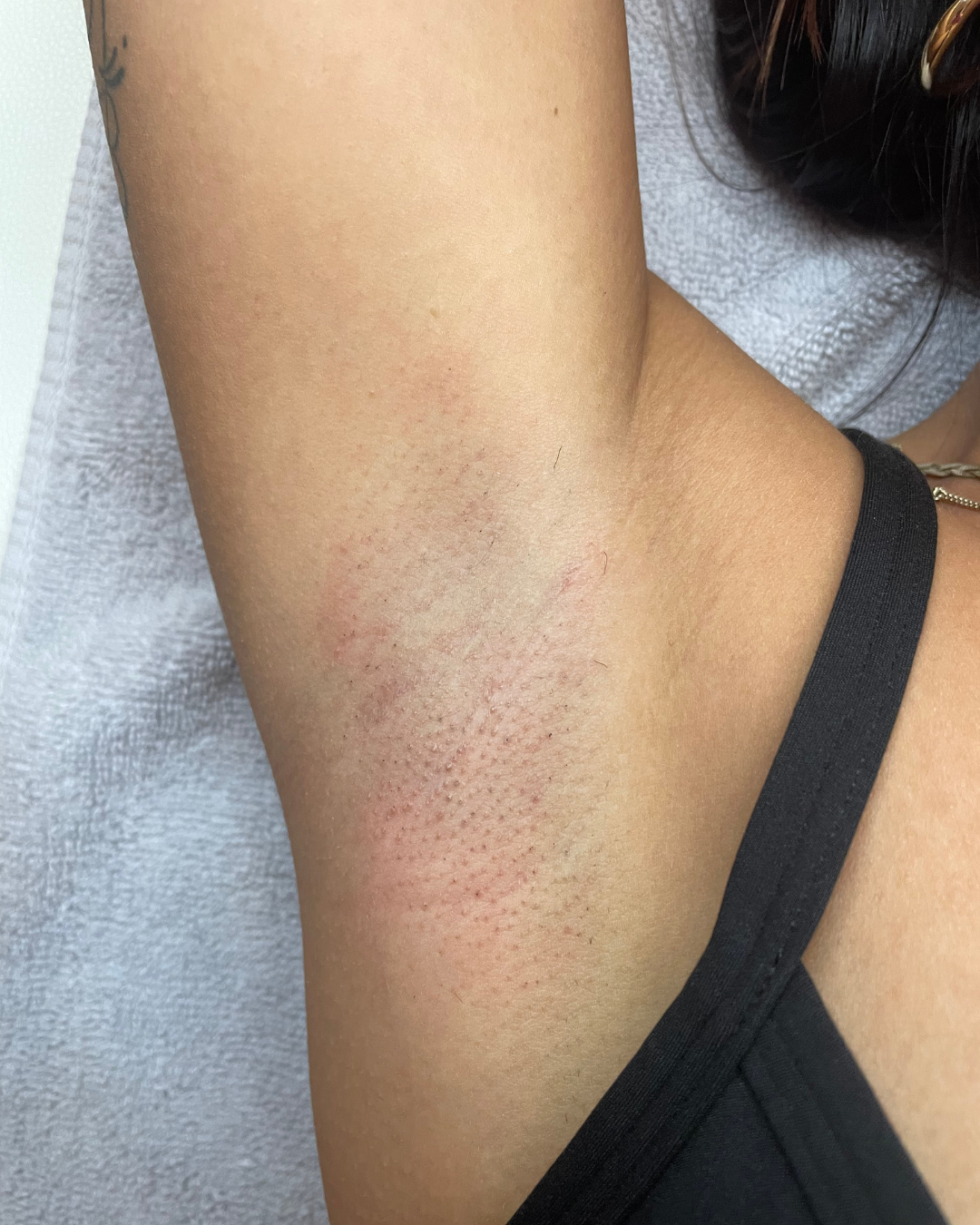 After Treatment