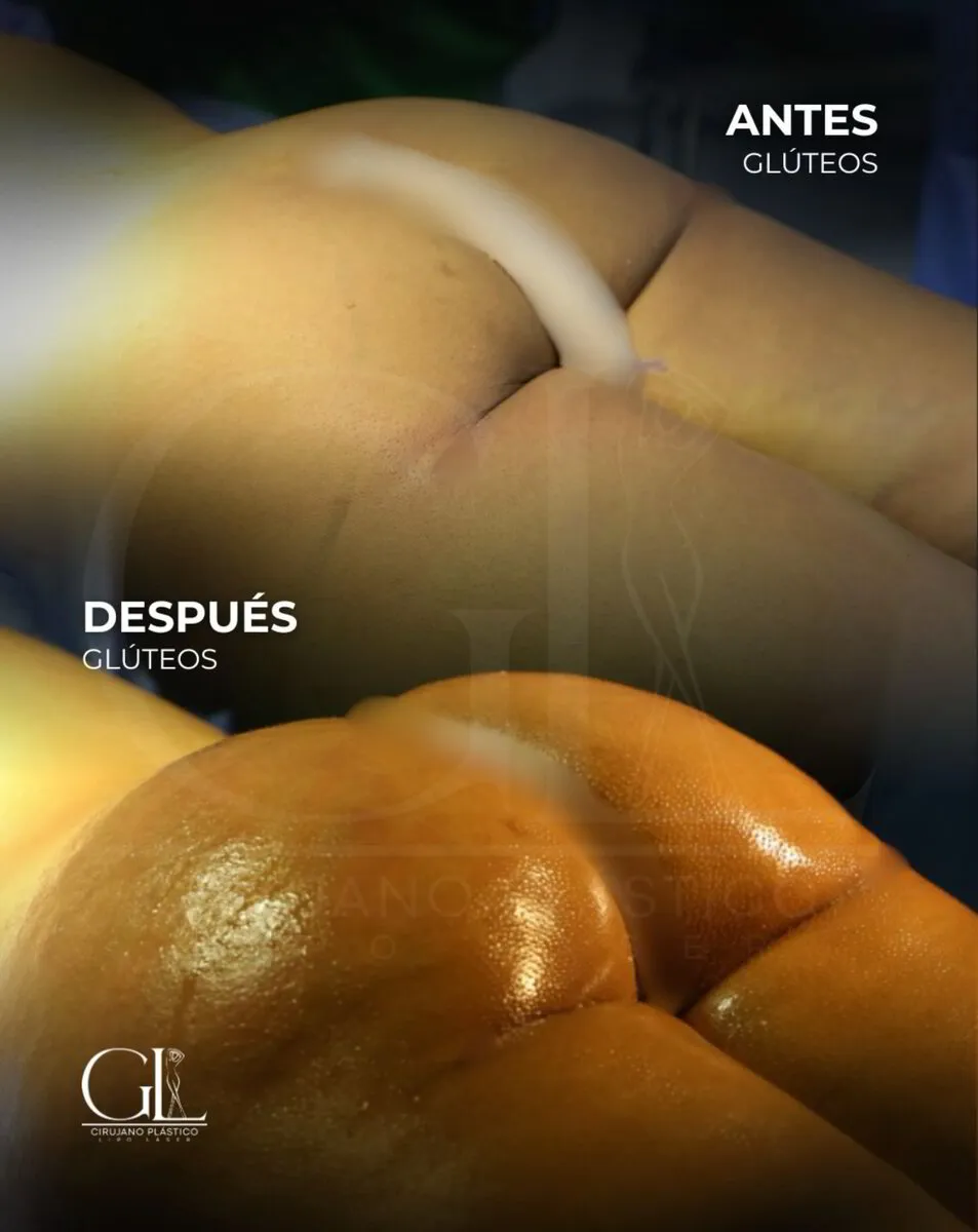 Lipoescultura de Glúteos