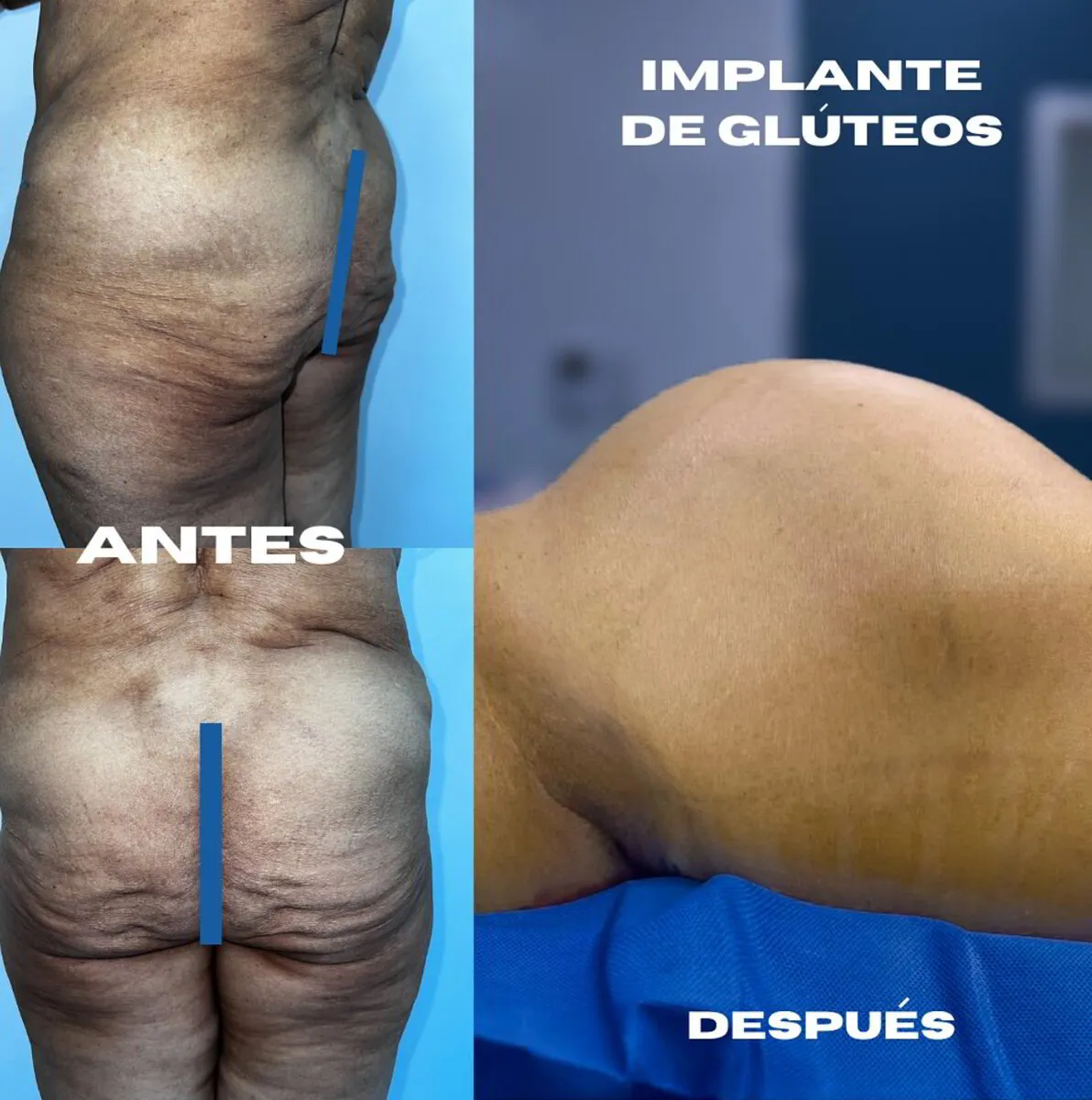 Implante de Glúteos