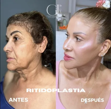 Ritidoplastia
