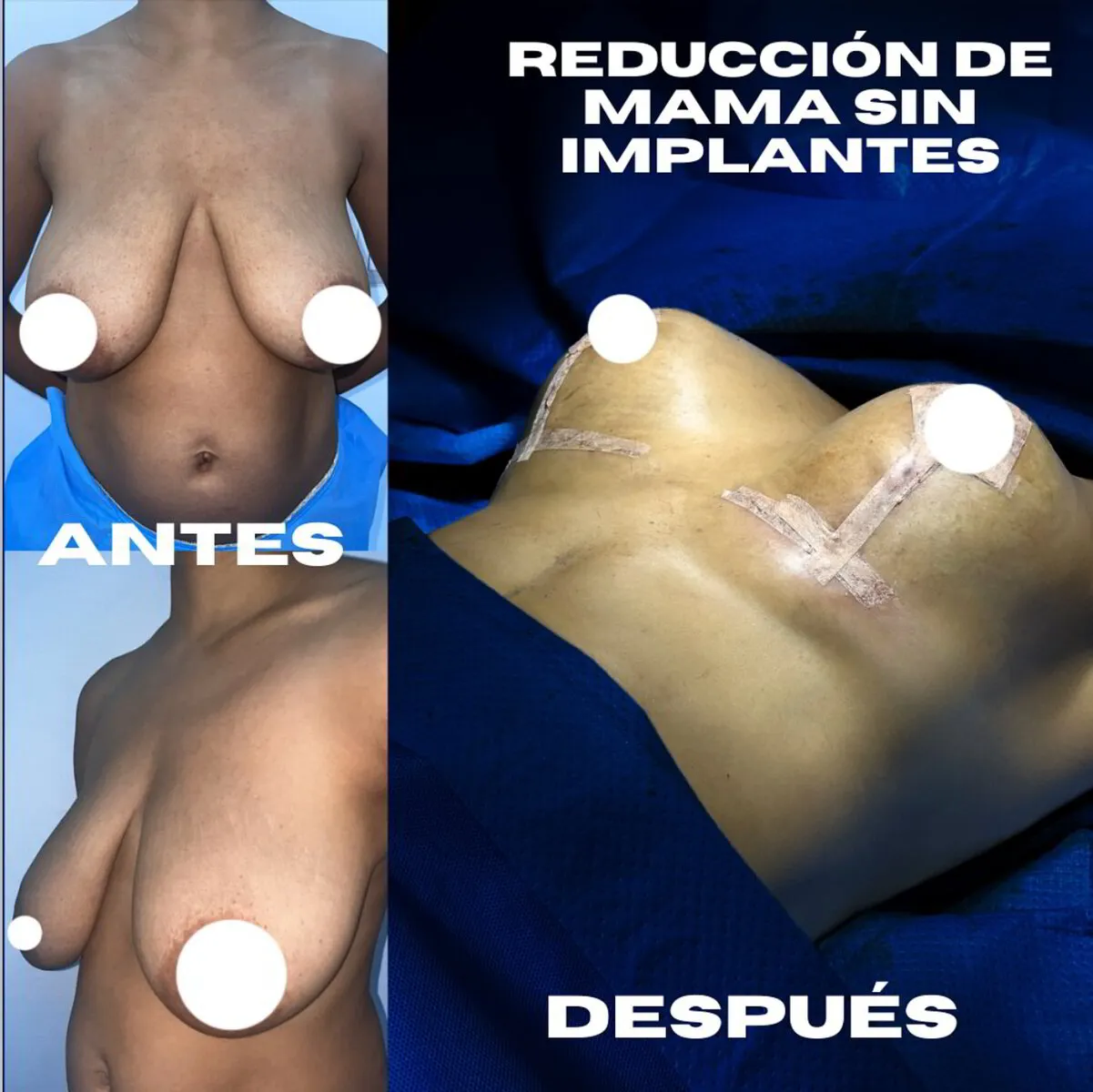 Reducción de Mama