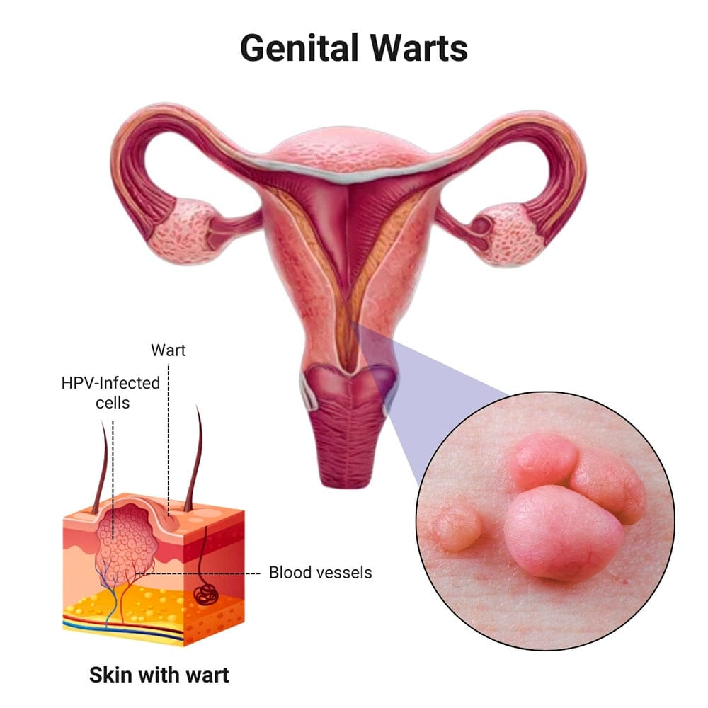 Anatomy of genital warts