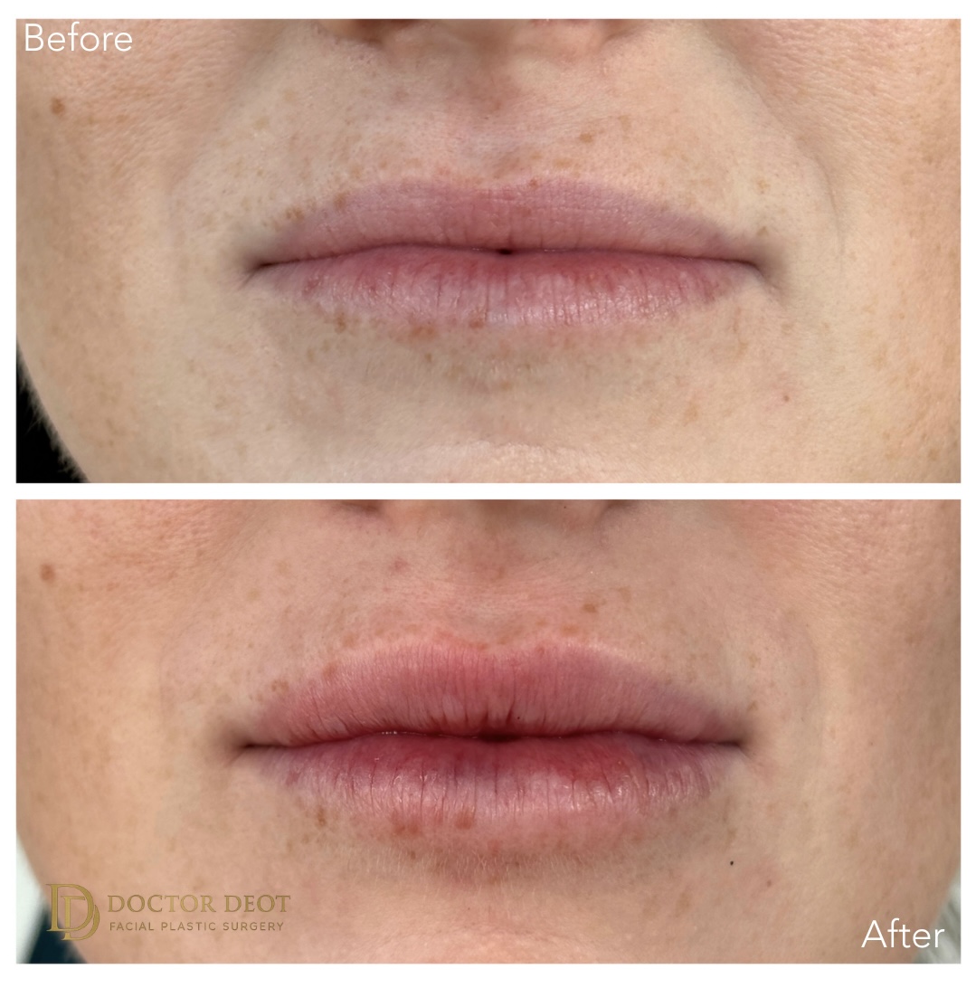 Lip Filler Before and After