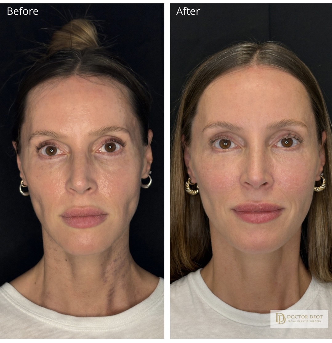 Facial Fat Grafting Before and After