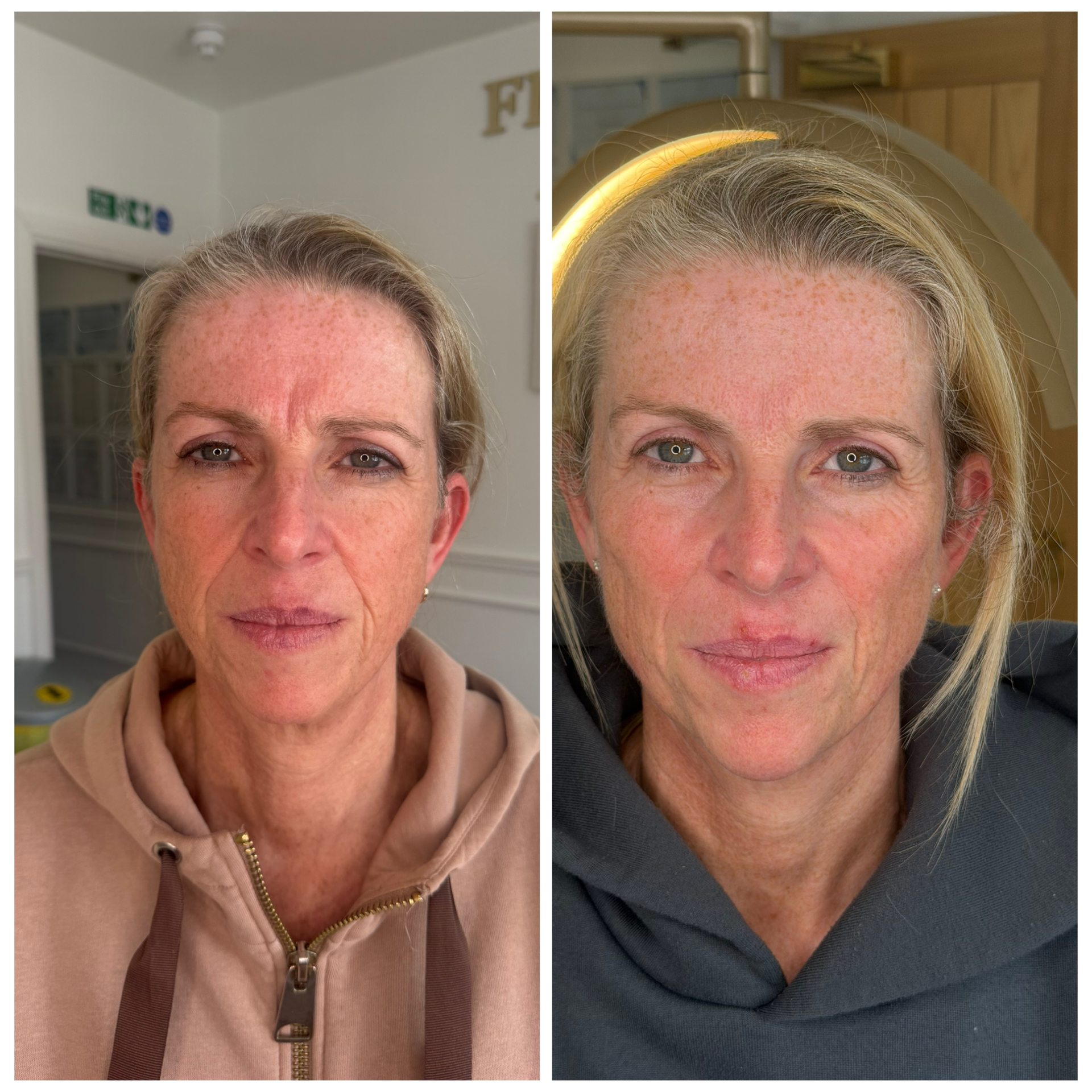 Dermal Fillers