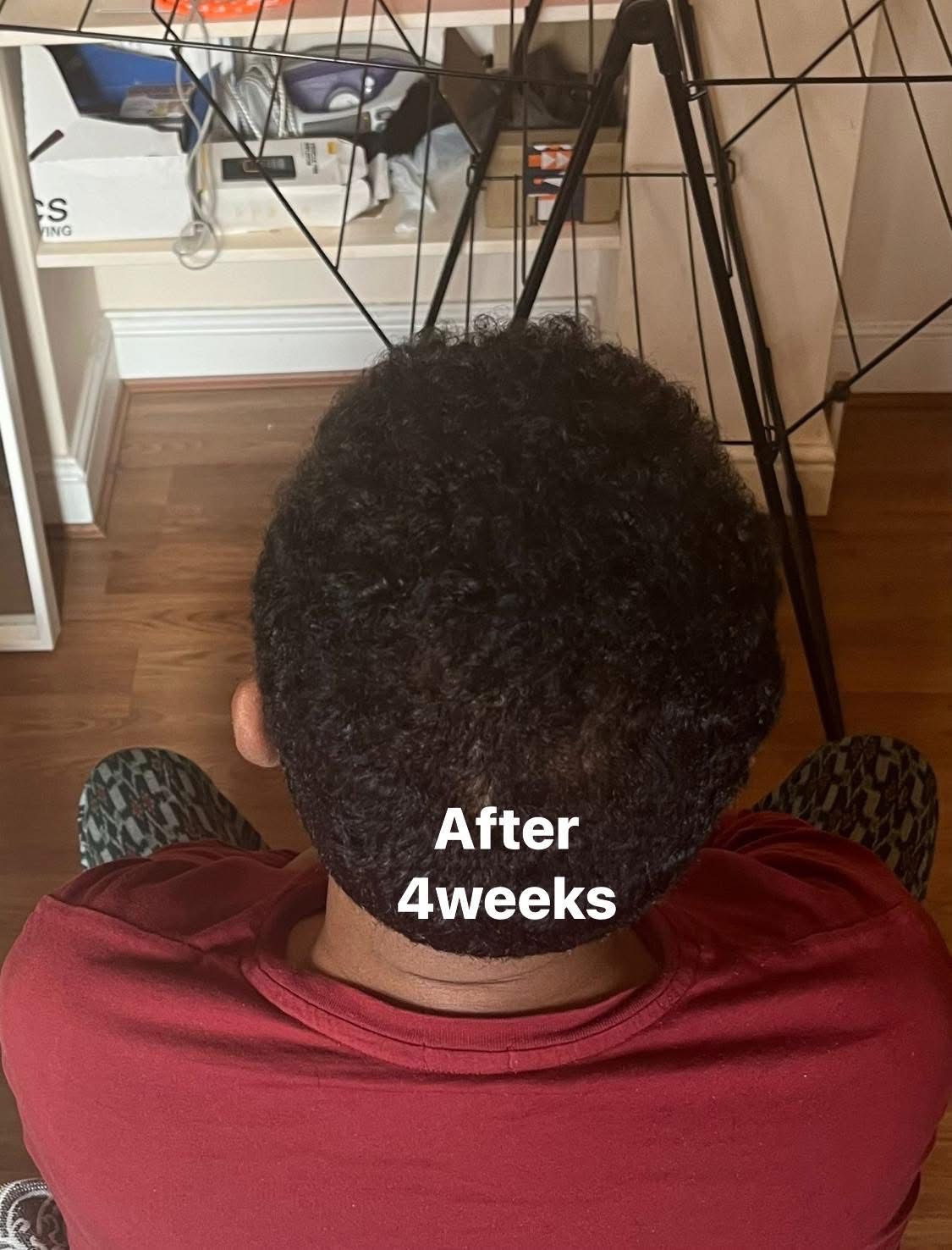 Hair Restoration