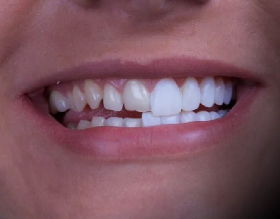Veneers & Cosmetics - Novera Dental Rosenberg TX