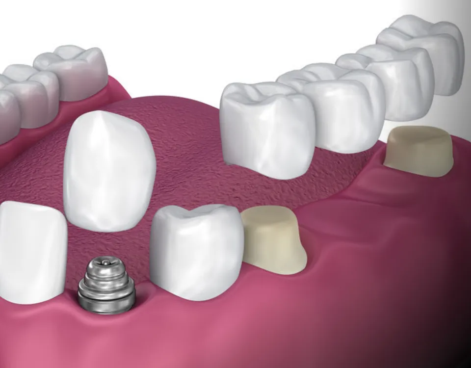 All-on-4 Implants - Novera Dental Rosenberg TX