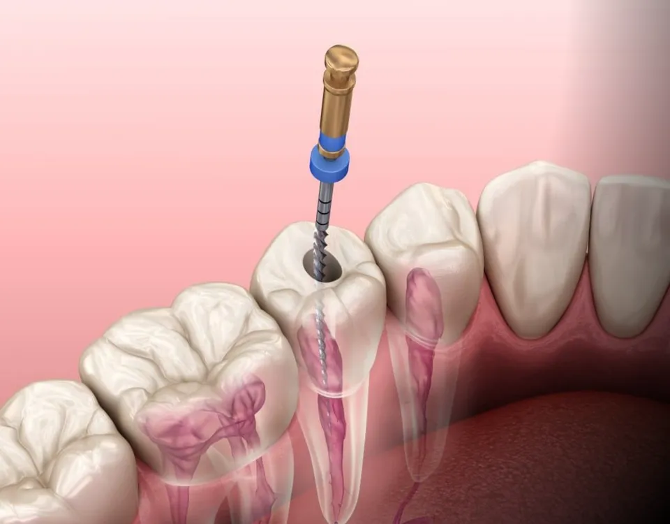 Wisdom Teeth & Surgery - Novera Dental Rosenberg TX