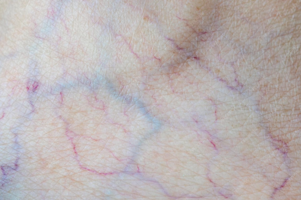 Thread Vein Removal