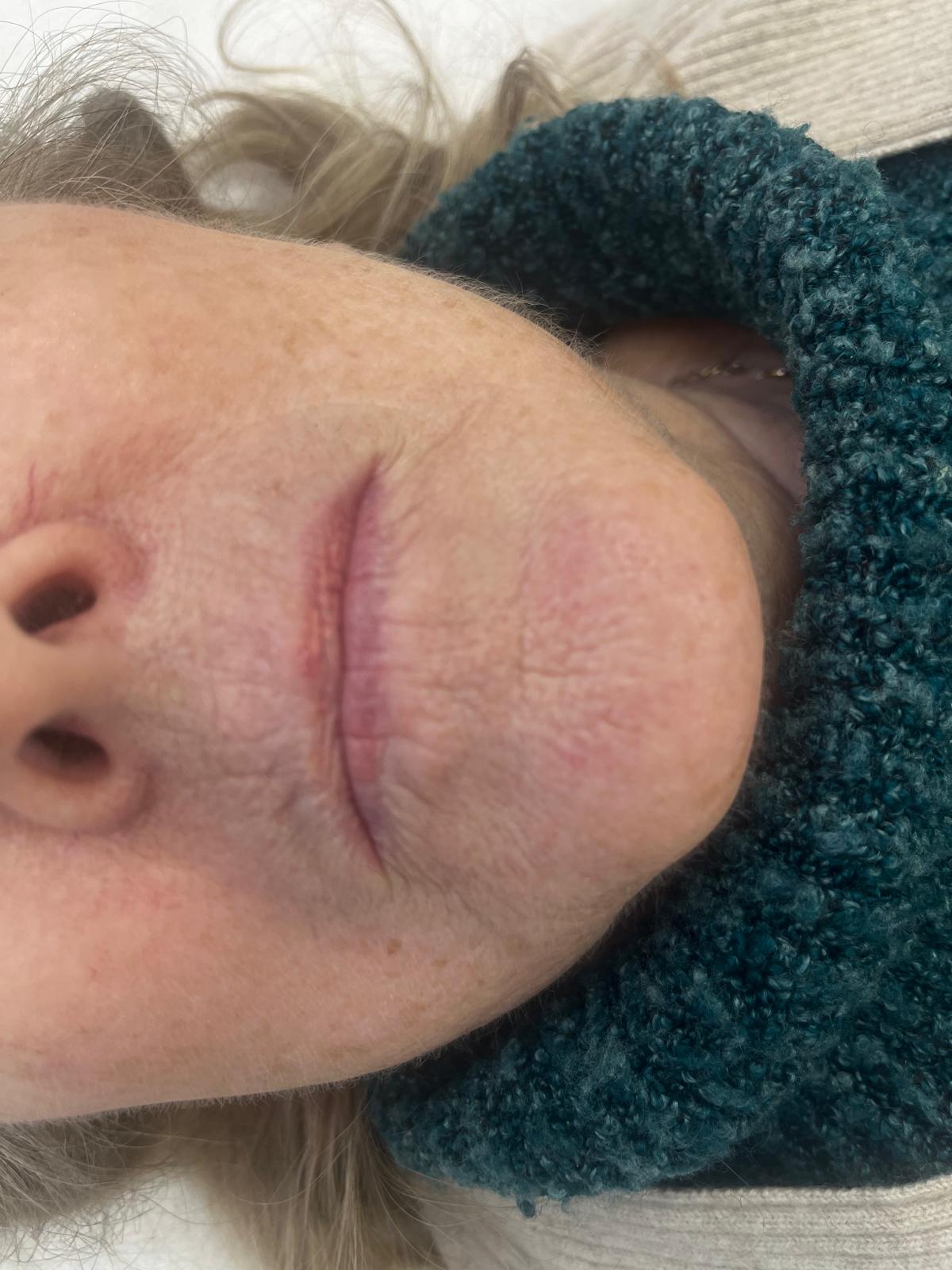 Lips Before