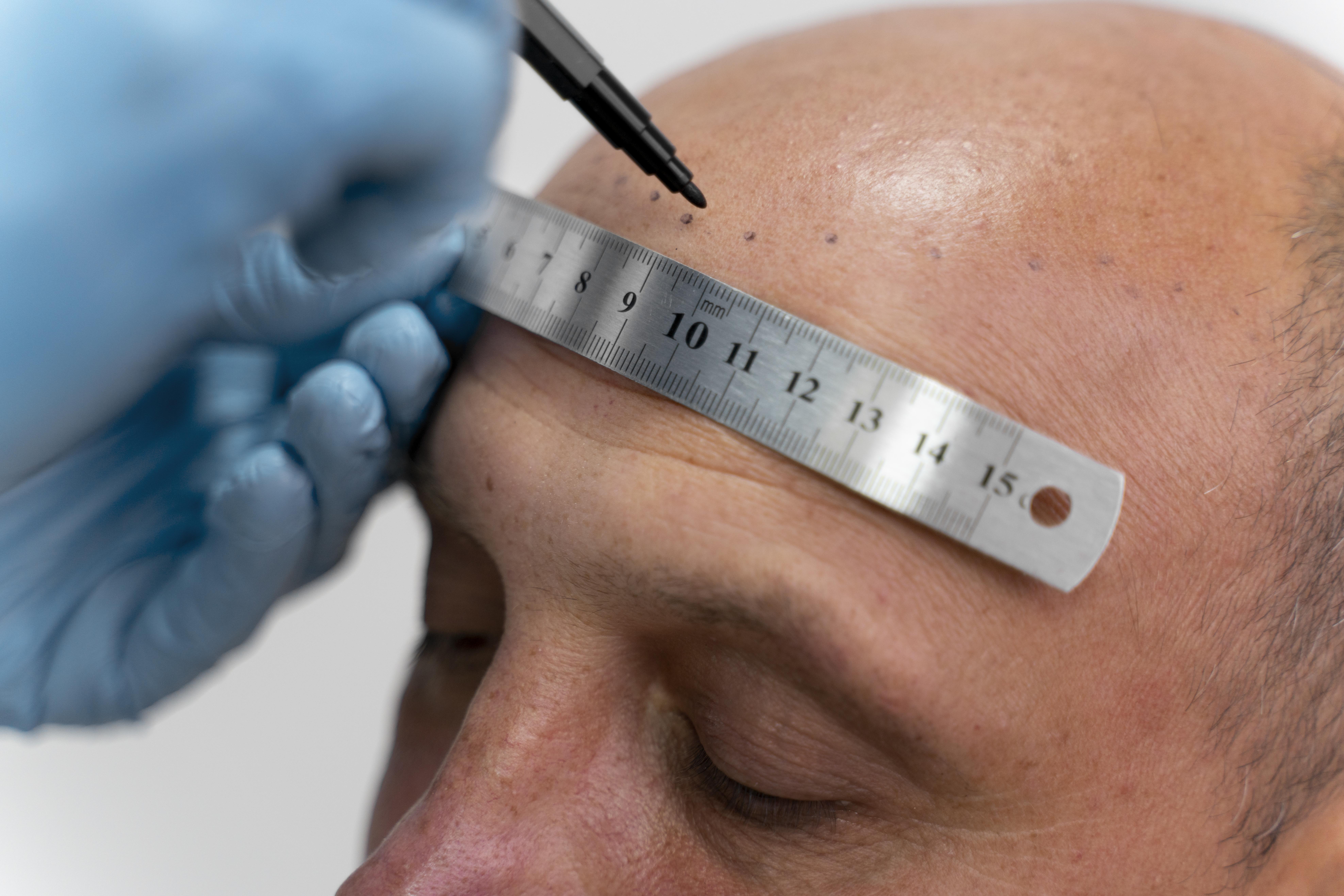 Medical Scalp Tattooing