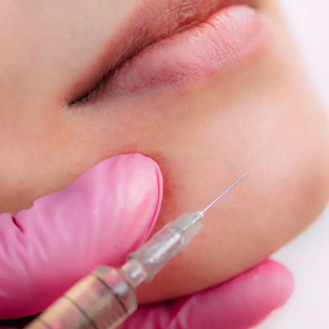 Profhilo Skin Treatment