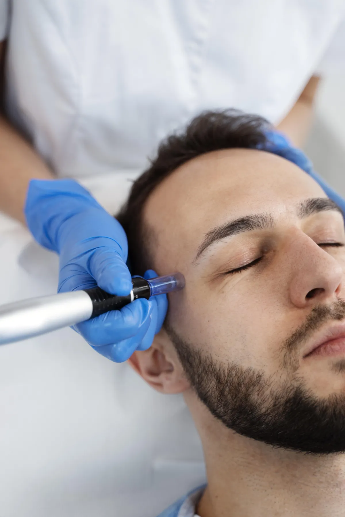 Microneedling