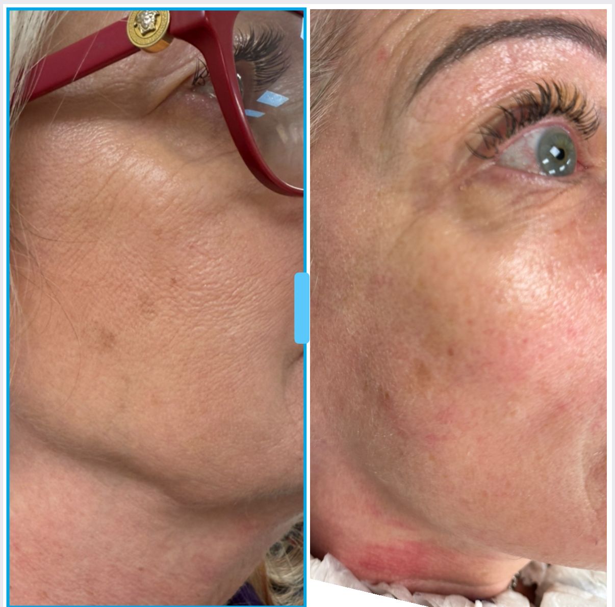 HIFU Face Treatment