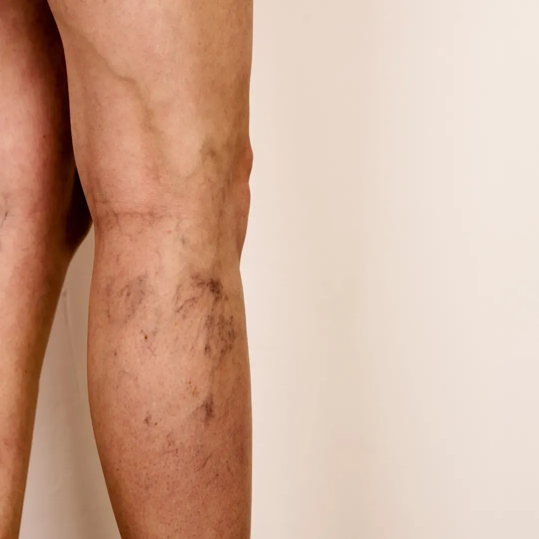 Vein Removal