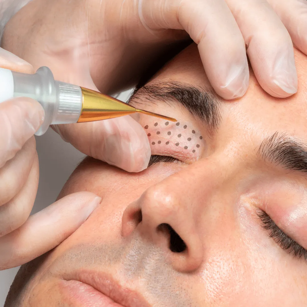 Plasma Skin Tightening