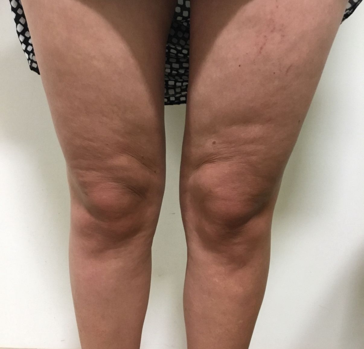 HIFU Knees Results