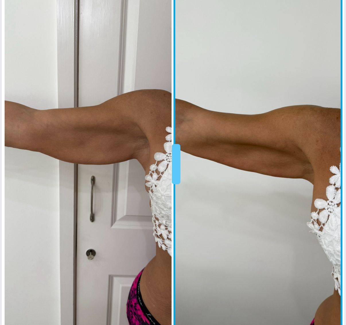 HIFU Upper Arms Results