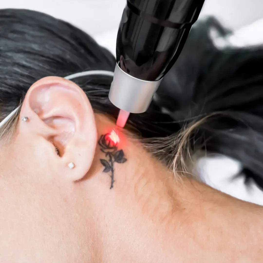 Laser Tattoo Removal