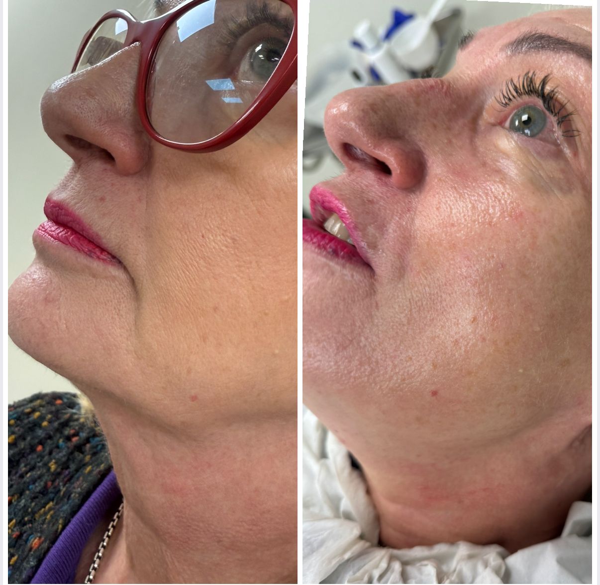 HIFU Face Results