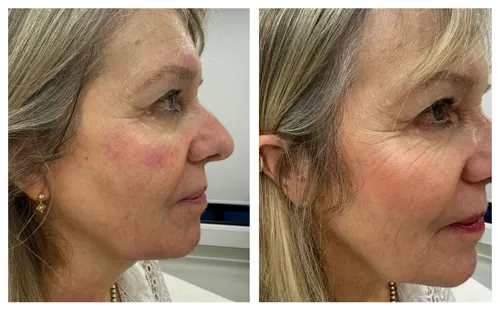 HIFU Face Results