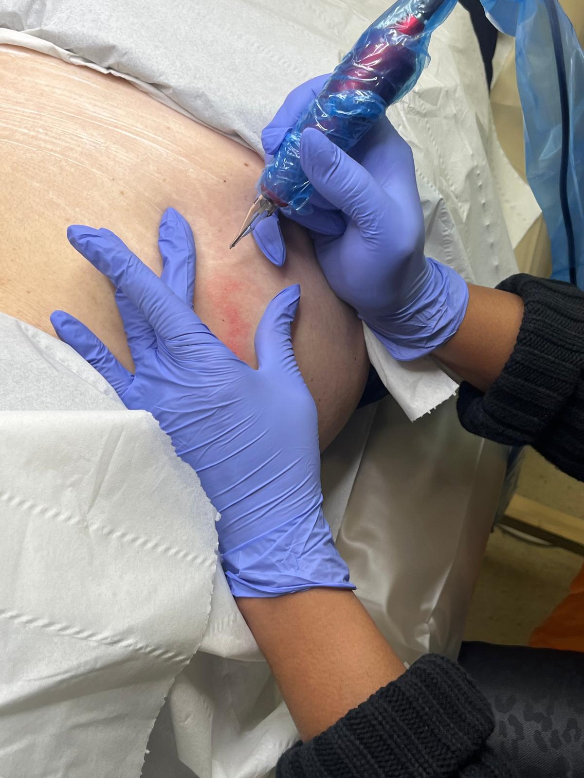 Scar Medical Tattooing