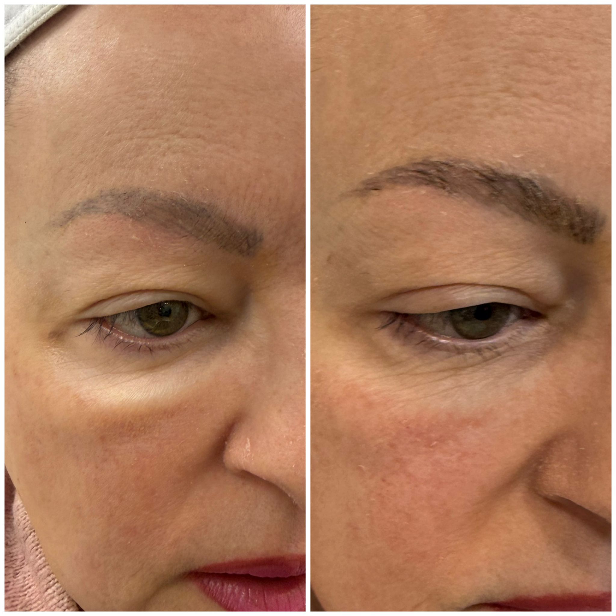 Venus Viva Under Eye Treatment Results