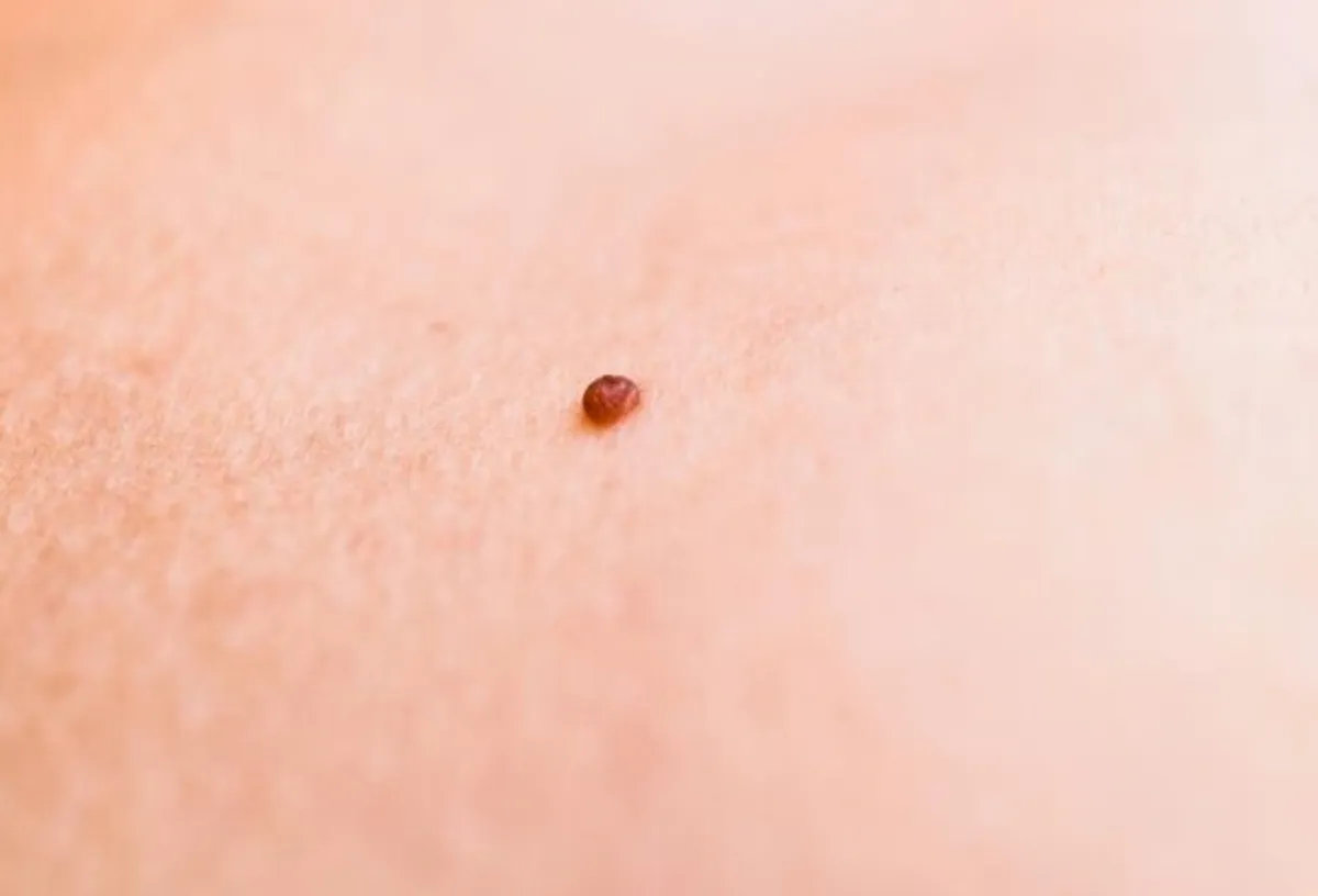 Skin Tag Removal