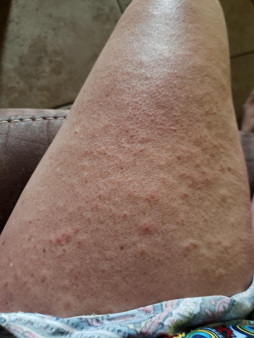 Close-up of a leg showing skin texture with red spots and bumps, highlighting chronic skin issues relevant to holistic health recovery and personal health journeys.