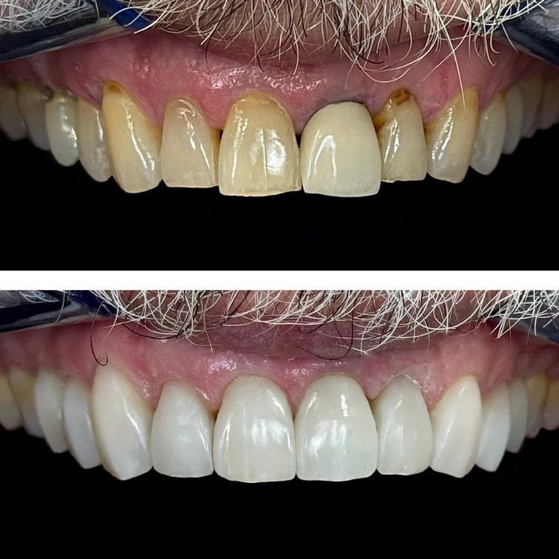 Before and After 13
