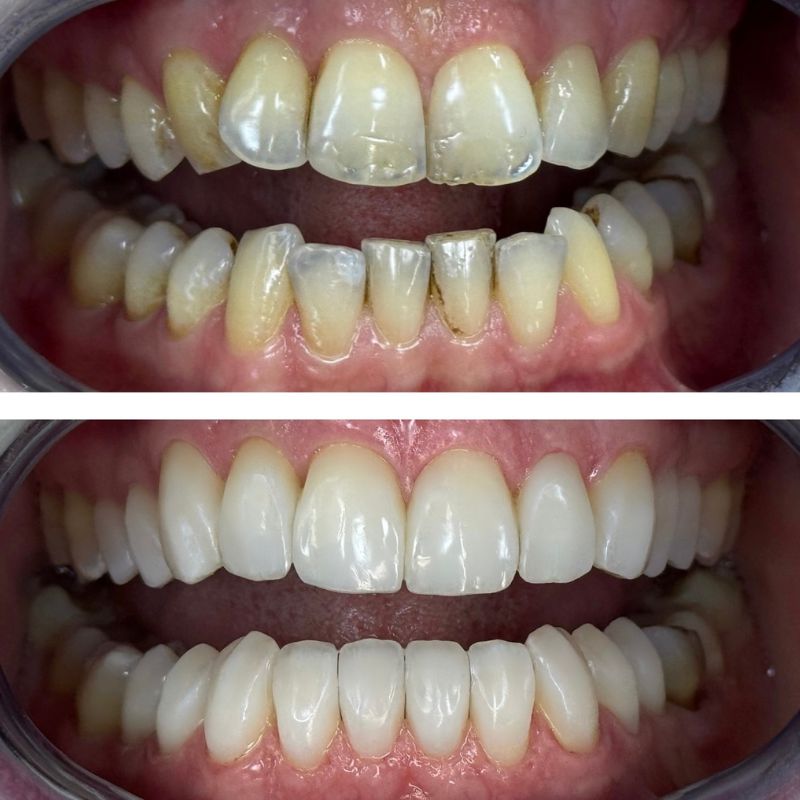 Before and After 11