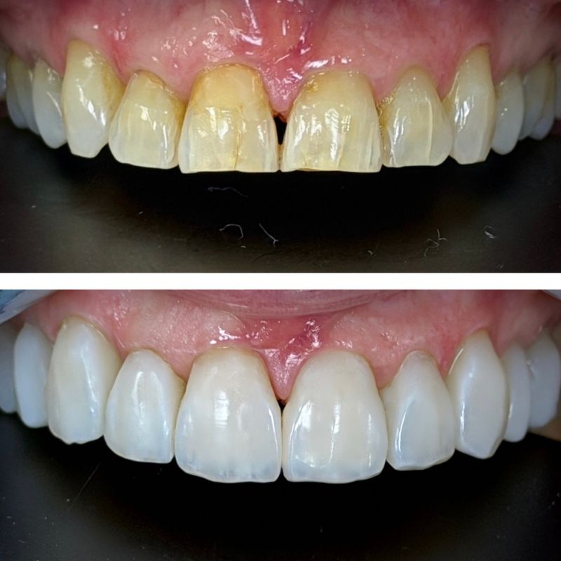 Before and After 2