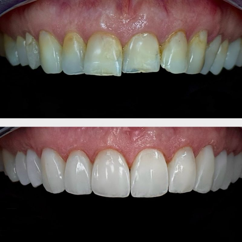 Before and After 15