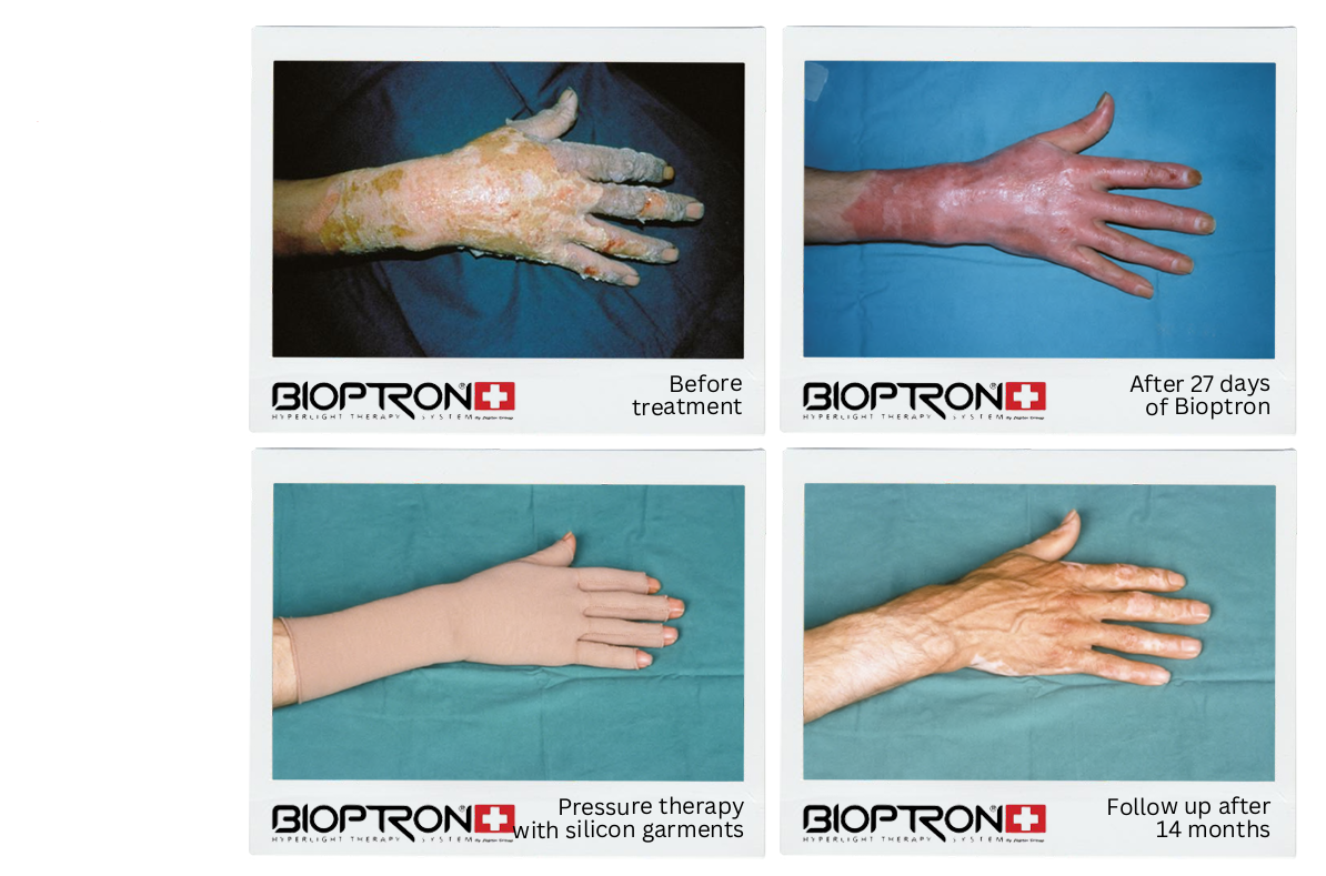 Hand burn healing progress with pressure therapy and Bioptron
