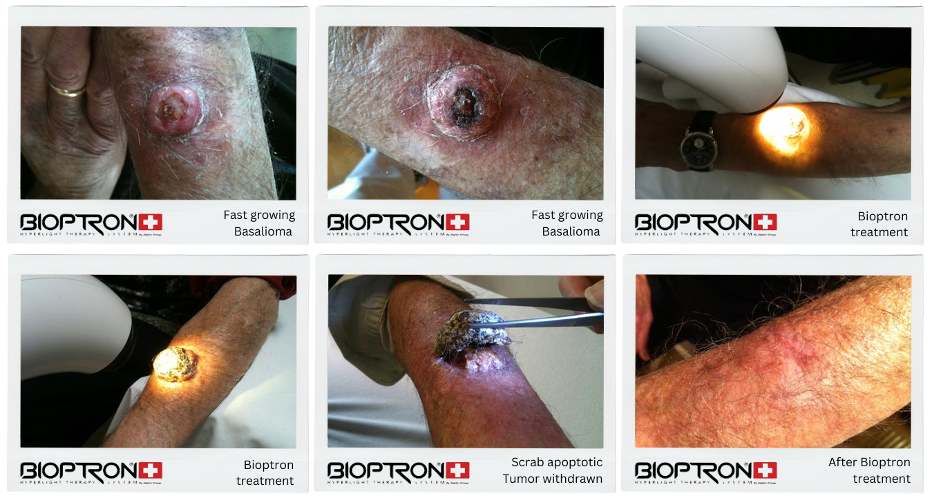 Basalioma treatment progress before and after