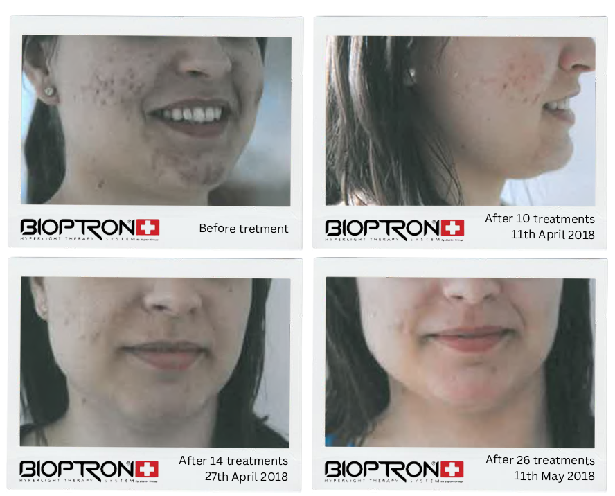 Acne treatment progress over several weeks