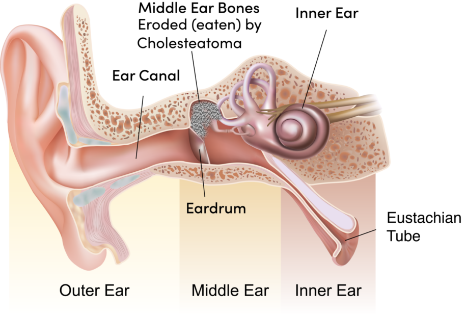 Cholesteatoma: A Hidden Threat in Ear Health