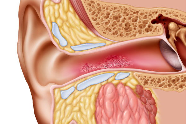 Swimmers Ear