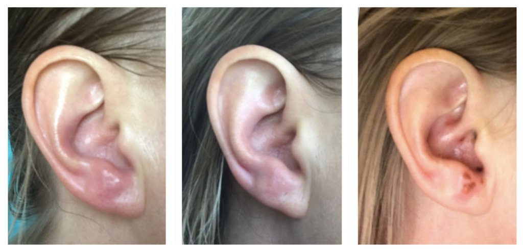 Ear Health: Recognising signs beyond wax blockage