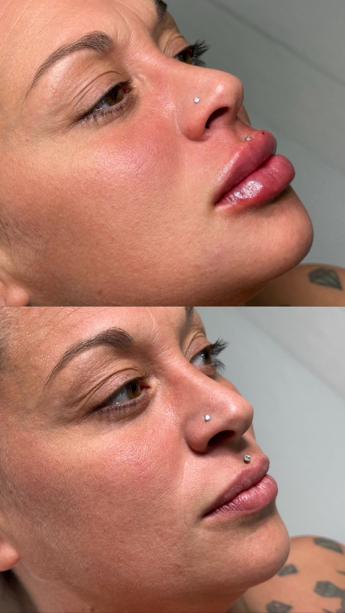 Antes y Después MN Clinic
