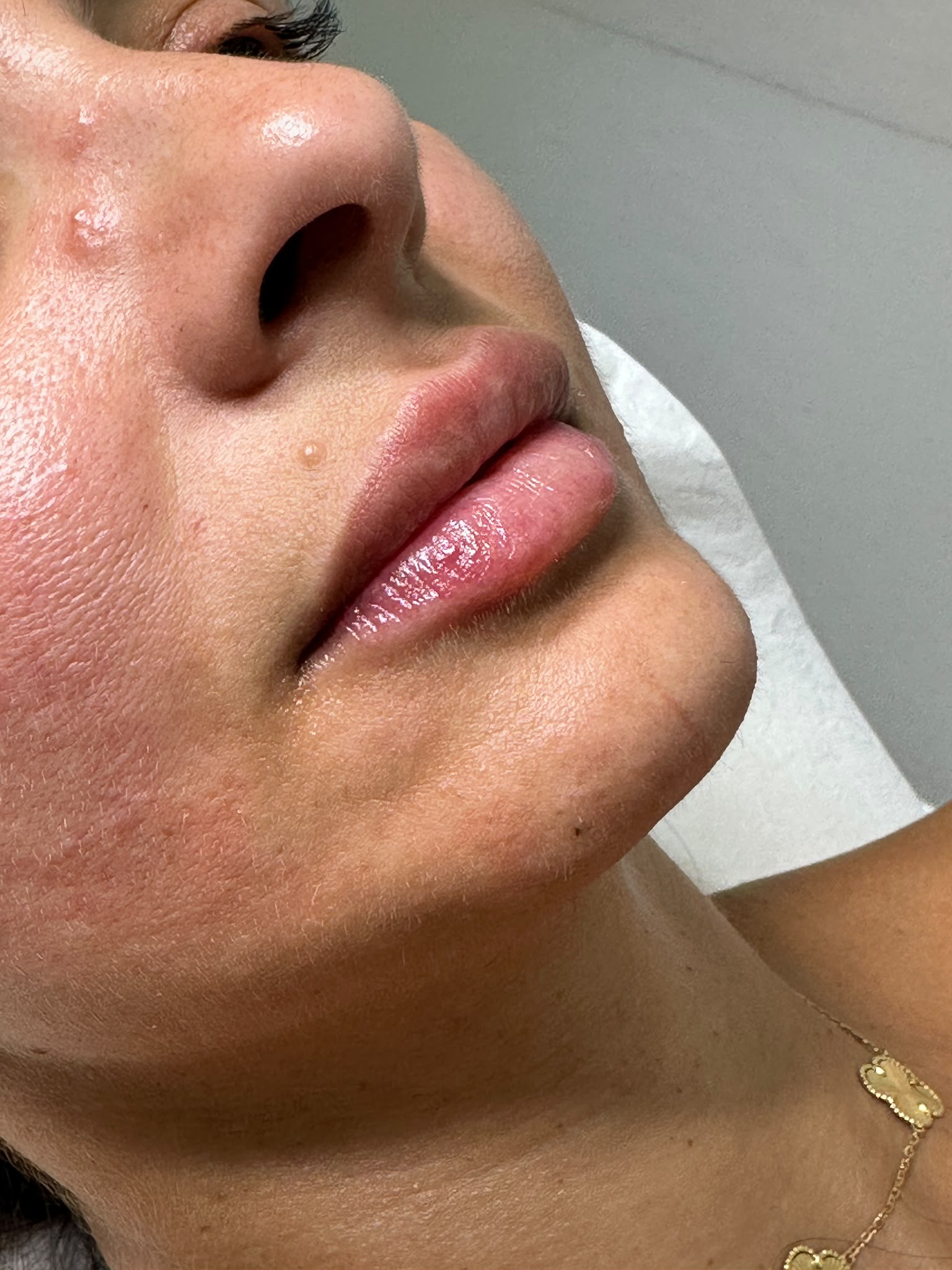 Aumento de Labios