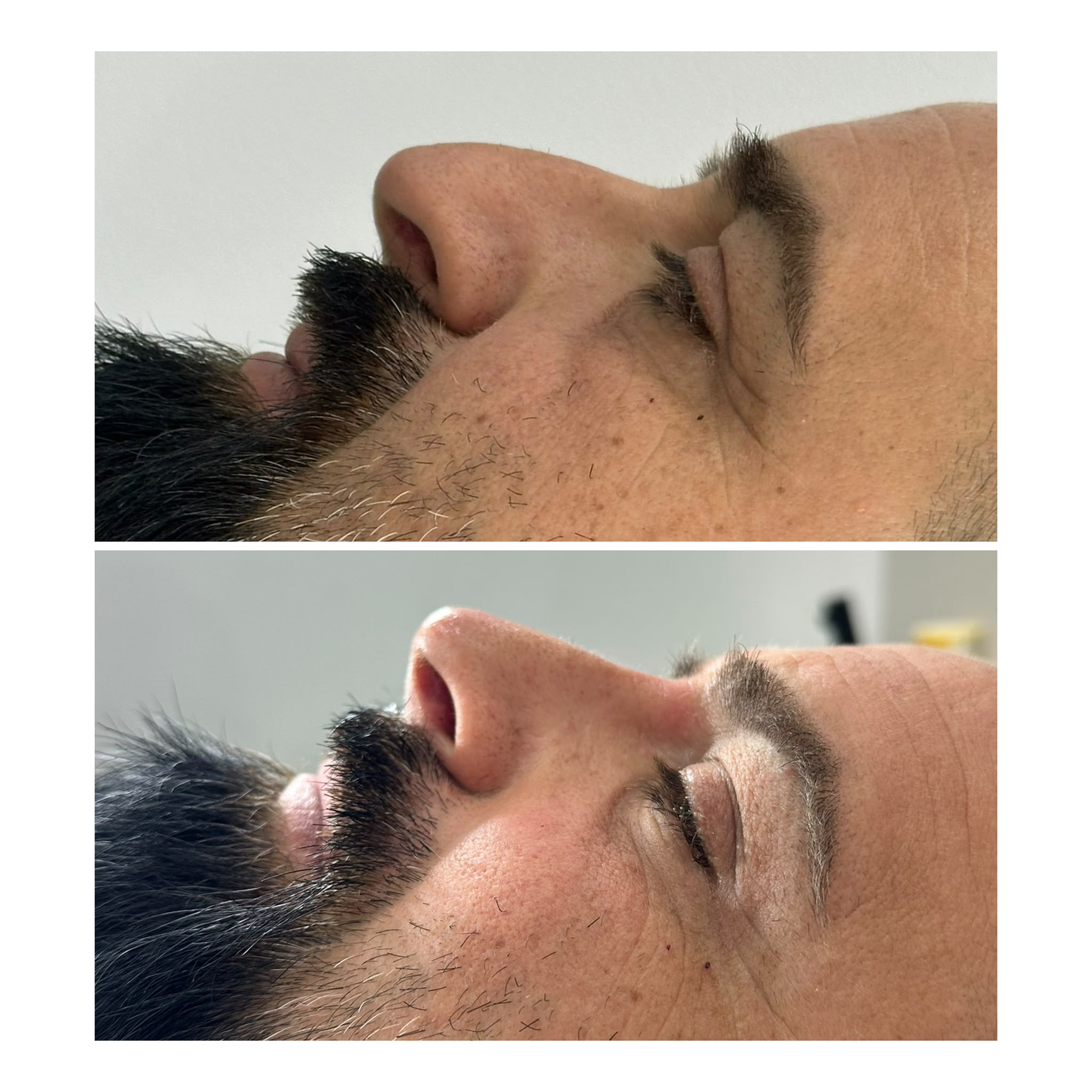 Antes y Después - Rinomodelación Sin Cirugía