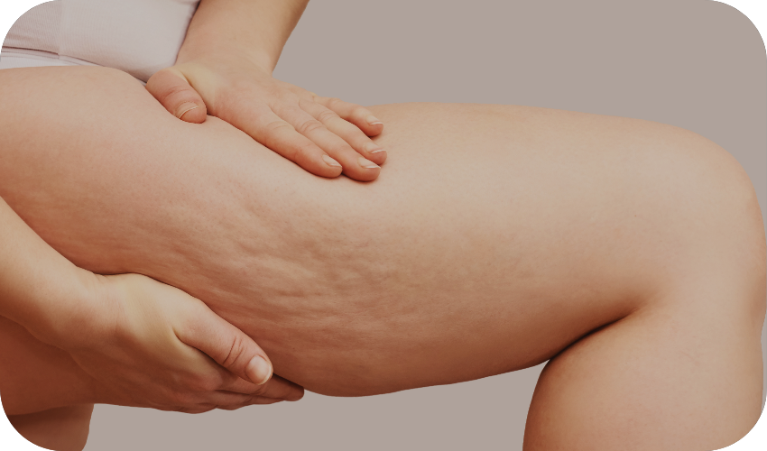 Inner thigh cellulite removal treatment at Body Empire Mississauga