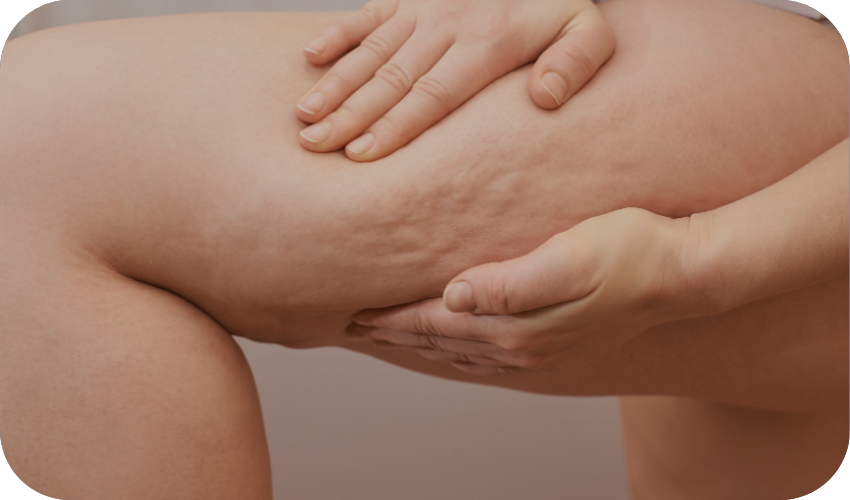Hamstring cellulite reduction treatment at Body Empire Mississauga