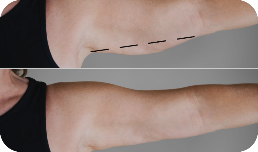 Bat Wing Arm Tightening in Mississauga