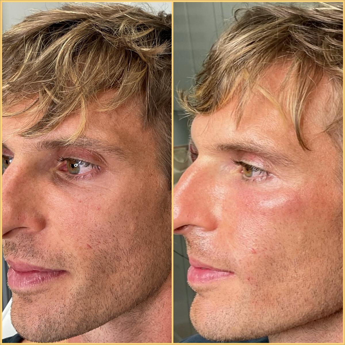 Under-Eye Dark Circles & Bags